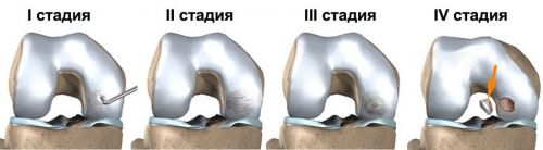 Развитие остеохондрита