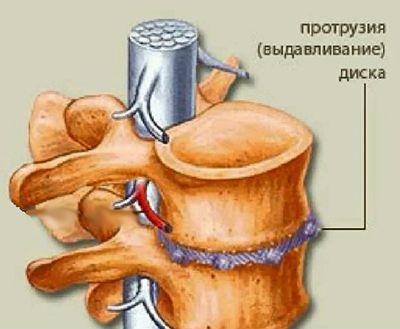 Протрузия межпозвонкового диска