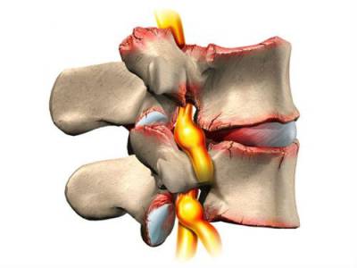 Поврежденные позвонки