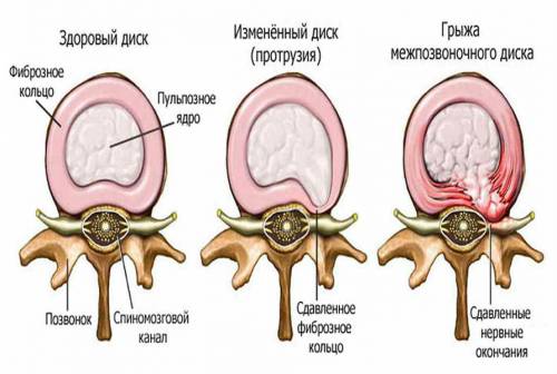 Формирование межпозвоночной грыжи