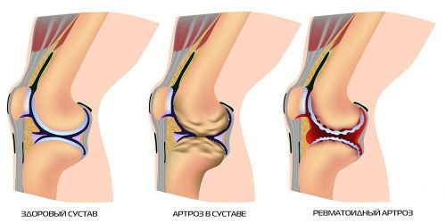 Артроз сустава