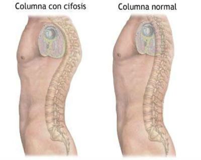 Кифоз грудного отдела 2 степени