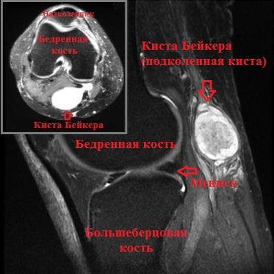 МРТ-снимок колена