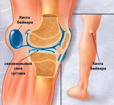 Киста Бейкера