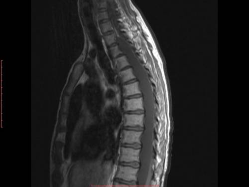 МРТ позвоночника