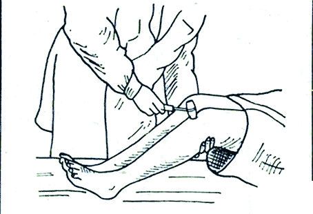 Проверка коленного рефлекса