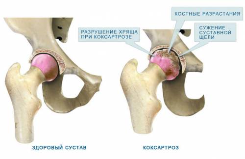 Повреждение сустава при коксартрозе