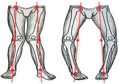 деформация ног