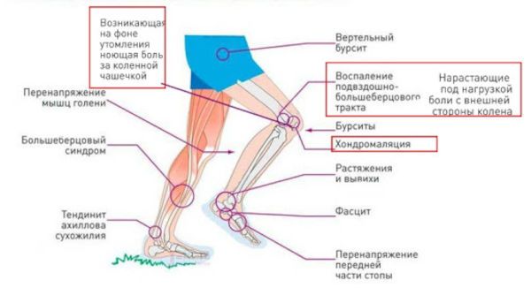 Травмы бегуна