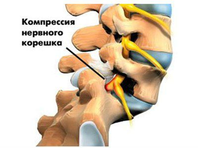 Компрессия нервного корешка