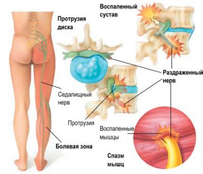 Механизм ущемления седалищного нерва