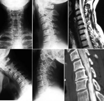 Рентгенография шейного позвоночника