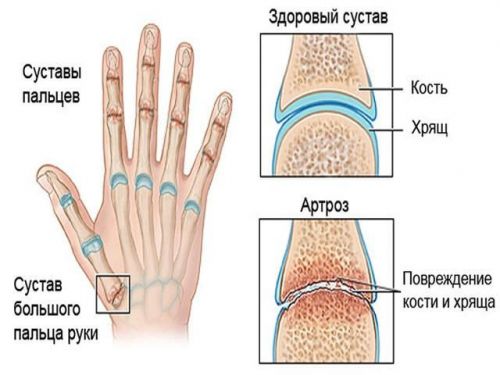 Суставы пальцев при артрозе