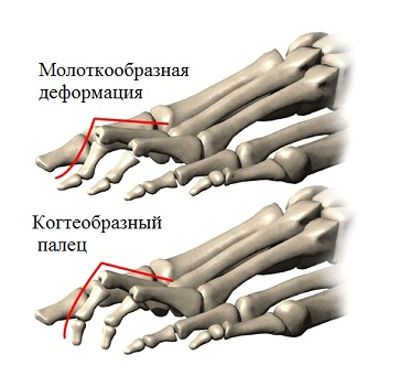 Деформация пальцев