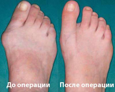 До и после операции при артрозе стопы