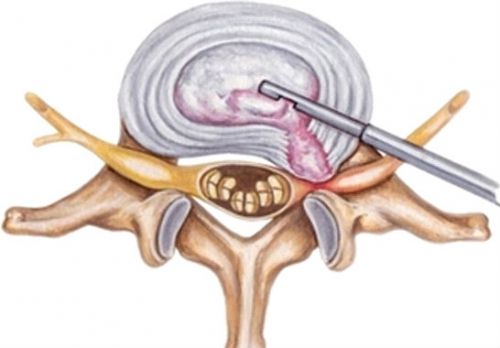 Лазерная вапоризация межпозвоночной грыжи