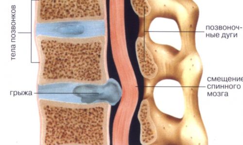 Межпозвоночная грыжа