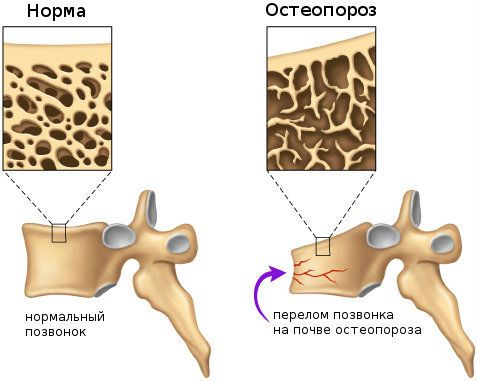 Остеопороз и перелом позвонка
