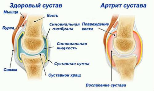 Изменения в суставе при артрите
