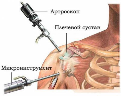 Артроскопия