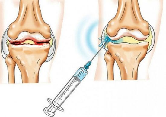 Внутрисуставная инъекция