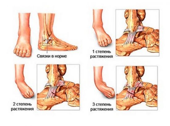 Вывих голеностопа