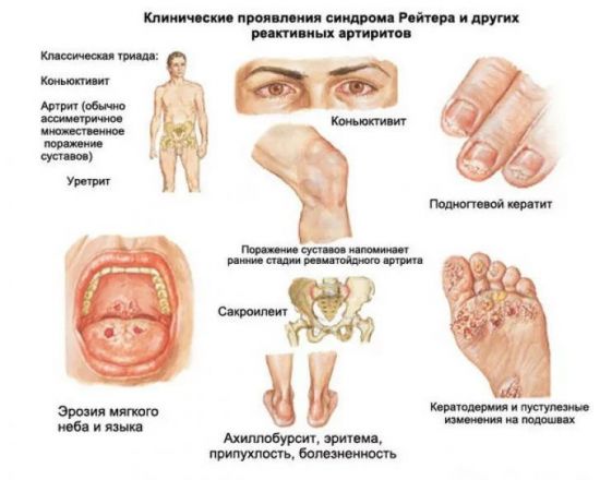 Симптомы синдрома Рейтера