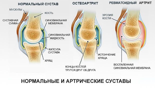 Нормальный сустав и артрит