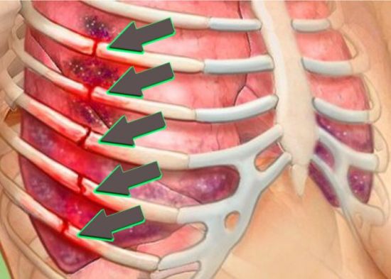 Перелом ребер