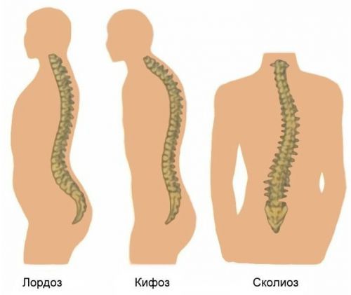 Искривление позвоночника
