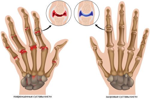 Артроз суставов кисти