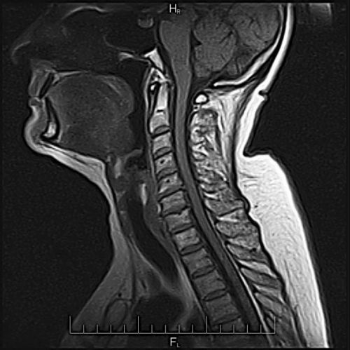 МРТ-снимок шеи