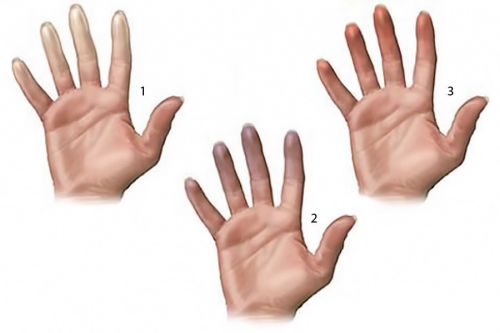 Пальцы при синдроме Рейно