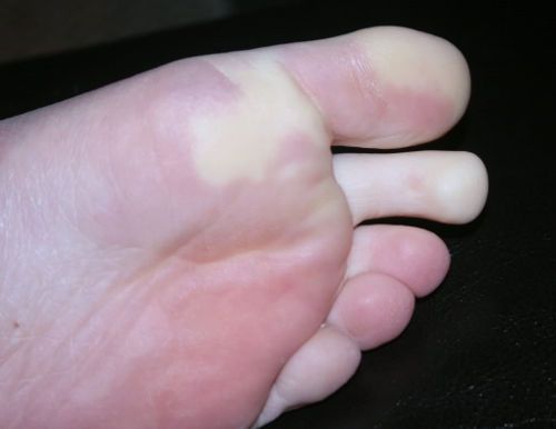 Побледнение пальцев ног
