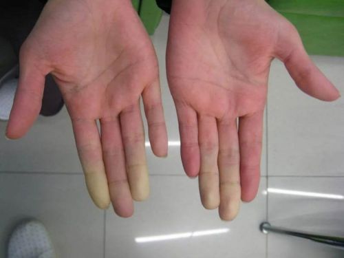 Белые пальцы рук