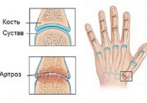 Артроз кисти