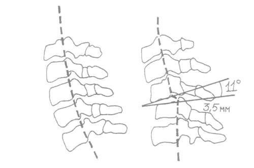 Критерии нестабильности шейных позвонков