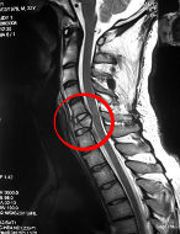 Перелом позвонка