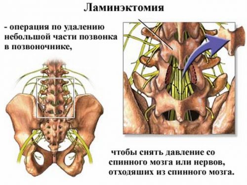 Ламинэктомия