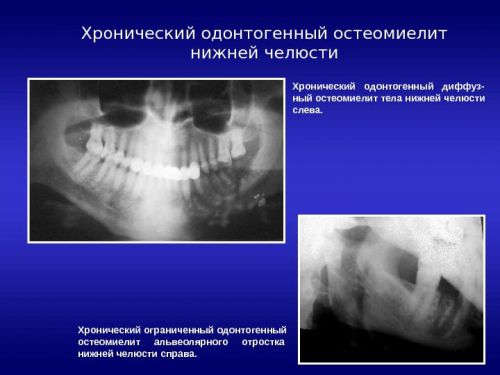 Рентген-снимки челюсти