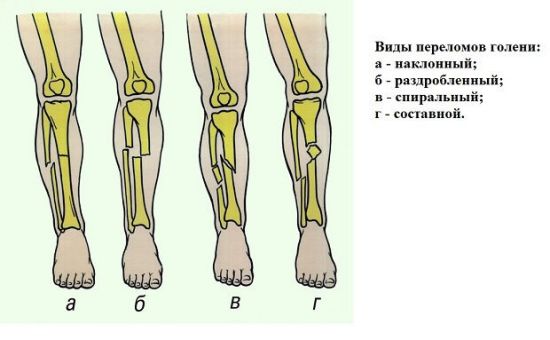 Виды переломов голени