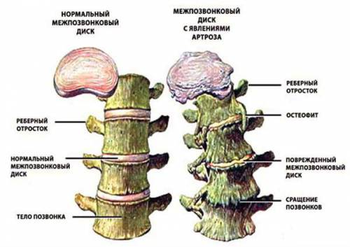 Здоровый и больной позвоночник