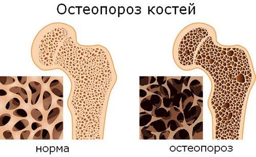 Структура кости: норма и патология
