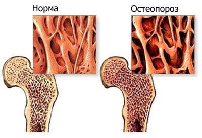нормальный сустав и пораженный остеопорозом