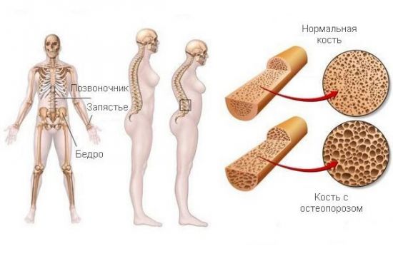 Кости при остеопорозе
