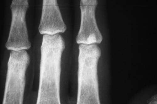 Остеосклероз фаланг пальцев рук