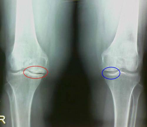 Субхондральный склероз коленных суставов