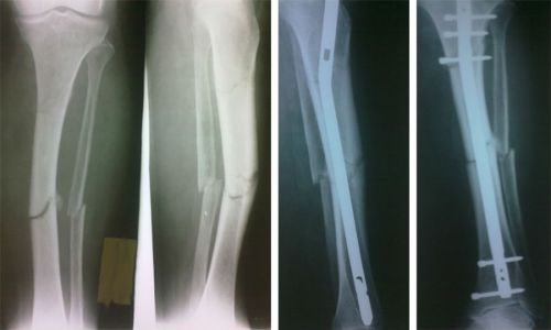 Рентгенография при переломе диафизов берцовых костей