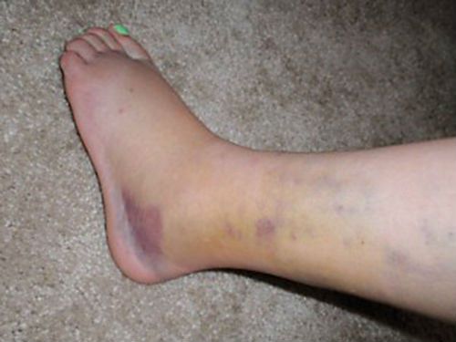 Травма ноги в голеностопе