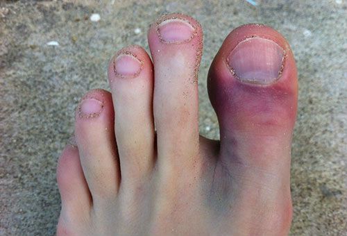 Травма первого пальца ноги